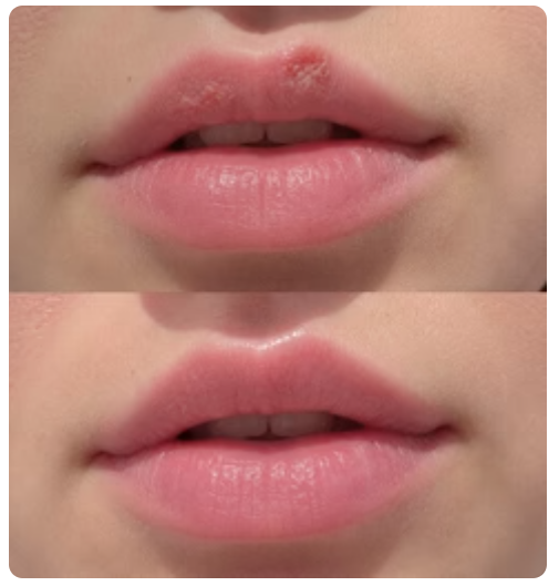 Emma lip comparison: Day 1 above and Day 4 below