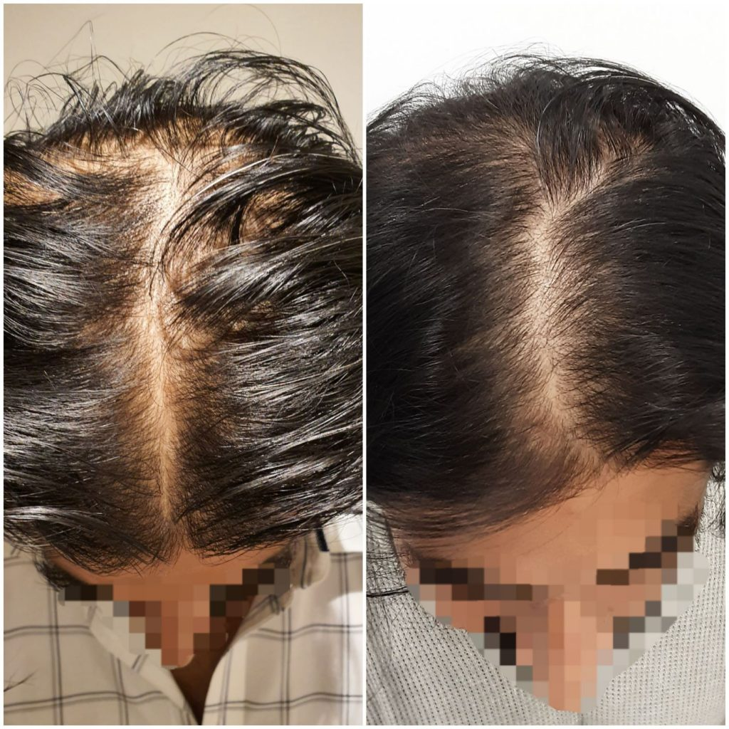 John hair before and after