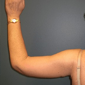 Lucifer after arm lift