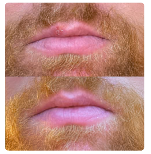 Thomas lip comparison: Day 1 above and Day 3 below